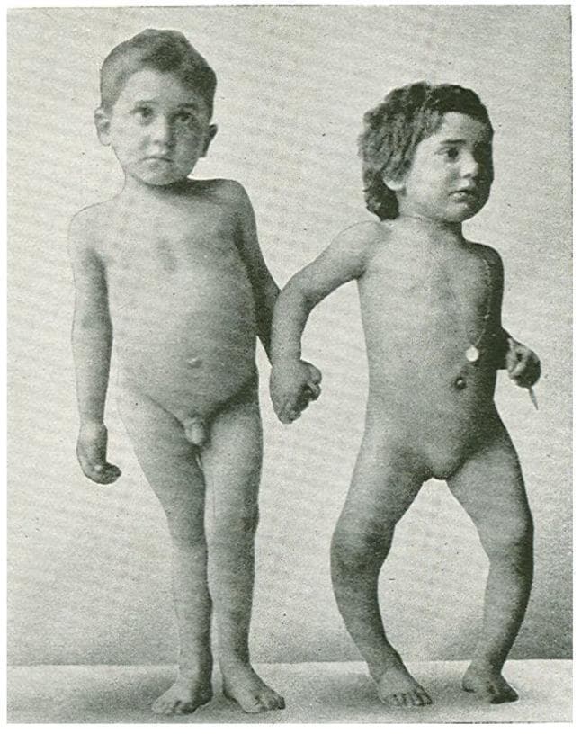 This clinical photograph displays a 6.5-year-old boy (left) and his 4-year-old sister (right) presenting with characteristic skeletal manifestations of rickets, likely secondary to severe vitamin D deficiency. The boy exhibits genu valgum (knock-knees), characterized by inward angling of the knees, while the girl demonstrates significant genu varum (bow legs), showing a lateral outward curvature of the femurs and tibiae. Both children show evidence of growth retardation (short stature for age) and additional skeletal deformities, including potentially widened epiphyses at the wrists and ankles. The image serves as a classic educational example of how nutritional or metabolic bone diseases interfere with proper mineralization of the growth plate, leading to progressive softening and bowing of weight-bearing long bones during childhood development.