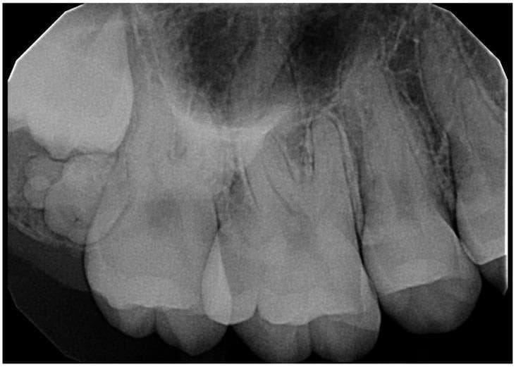 A periapical radiograph of the posterior maxilla demonstrates a compound odontoma hindering the eruption of the third molar. The lesion presents as a well-defined, irregular radiopaque mass composed of multiple small, tooth-like structures (denticles) of varying sizes and shapes. A thin, radiolucent rim surrounds the mass, consistent with a fibrous capsule. The odontoma is positioned coronal to the impacted third molar and distal to the second molar, causing displacement of the erupting tooth. Key anatomical landmarks include the maxillary sinus, appearing as a superior radiolucent area, and the first and second molars with visible periodontal ligament spaces and lamina dura. The trabecular bone pattern of the alveolar process is evident throughout the field. This diagnostic image illustrates a common odontogenic tumor and its clinical consequence of tooth impaction, relevant for dental radiology and oral surgery education.