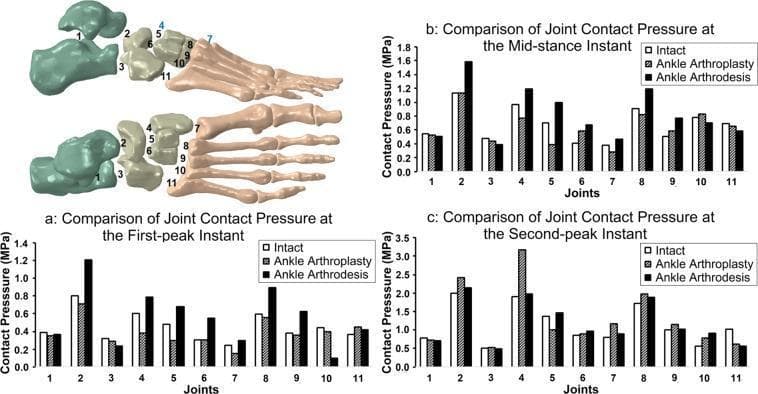 This medical graphic presents a biomechanical comparison of joint contact pressure across three foot models: intact, total ankle arthroplasty (TAA), and ankle arthrodesis. The visual includes an anatomical diagram of the foot bones with 11 numbered joints and three bar graphs corresponding to specific phases of the gait cycle: (a) first-peak, (b) mid-stance, and (c) second-peak instants. The 11 joints analyzed include the subtalar (1), talonavicular (2), calcaneocuboid (3), medial cuneonavicular (4), intermediate cuneonavicular (5), lateral cuneonavicular (6), and the five tarsometatarsal joints (7–11). The data shows that ankle arthrodesis generally results in significantly higher contact pressures, particularly at the talonavicular and medial cuneonavicular joints, compared to the intact foot. TAA generally shows a closer approximation to intact pressure levels, though it exhibits a distinct pressure spike at the medial cuneonavicular joint during the second-peak instant. This educational content illustrates how surgical interventions like fusion or replacement alter load distribution across the midfoot and forefoot during walking.