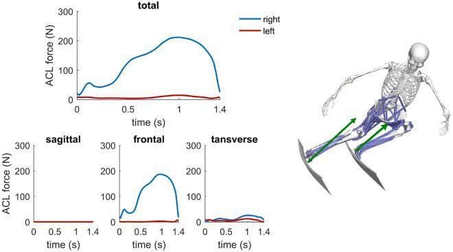 This medical biomechanics graphic illustrates Anterior Cruciate Ligament (ACL) force distribution during a downhill skiing turn. The visual contains a series of line graphs and a 3D musculoskeletal model. The primary 'total' graph displays ACL force in Newtons (N) over a 1.4-second interval for the right knee (blue) and left knee (red). The right knee, acting as the outside leg in the turn, shows a significant peak force of approximately 211 N at 1 second, whereas the left knee (inside leg) remains near baseline. Supporting secondary graphs break down these forces into three planes: sagittal, frontal, and transverse. Comparison of these planes reveals that the frontal plane is the dominant contributor to the total ACL force on the outside leg, likely due to external abduction moments. To the right, a musculoskeletal simulation shows a skeleton with highlighted musculature and green vectors representing ground reaction forces acting on the skis. This content is designed for advanced orthopedic and sports medicine education regarding injury mechanisms and ligament loading during high-impact athletics.