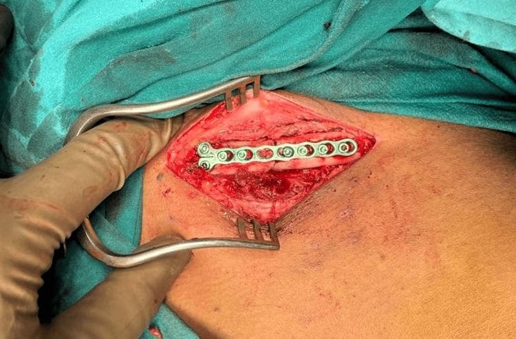 An intraoperative clinical photograph showing the open reduction and internal fixation (ORIF) of a medial end clavicle fracture. The surgical site is exposed through an anterior approach, with the skin and underlying soft tissues retracted using a self-retaining retractor to reveal the clavicle. A 2.4-mm mini fragment system locking compression plate (LCP) is fixed to the anterior surface of the bone across the fracture line. The metallic plate features seven holes, with multiple locking screws visible, providing stable fixation and alignment of the cortical bone. The surrounding surgical field is bordered by green sterile drapes, and the exposed muscle and connective tissues show normal surgical hyperemia. This image demonstrates orthopedic surgical techniques for stabilizing clavicular fractures using low-profile plating systems.