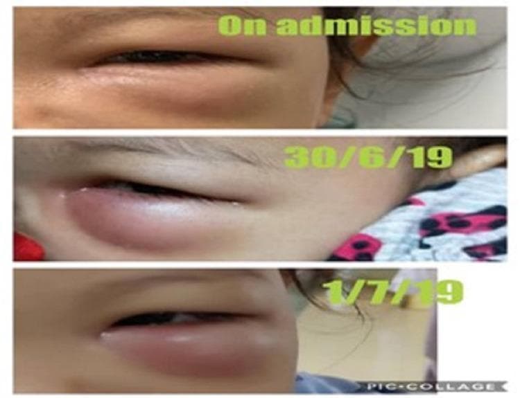 A series of three clinical photographs arranged as a vertical timeline demonstrating the progression of left-sided periorbital cellulitis in a pediatric patient. The first image ('On admission') shows moderate edema of the left upper and lower eyelids with mild erythema. The second image ('30/6/19') shows a significant increase in inflammatory swelling, characterized by tense, erythematous skin and worsening ptosis of the upper eyelid. The final image ('1/7/19') depicts generalized, severe periorbital edema that almost completely obscures the globe, with the skin appearing stretched and shiny due to underlying inflammation. This timeline illustrates the clinical worsening of preseptal cellulitis despite initial antibiotic treatment, which was later attributed to an odontogenic infection and orbital periosteal abscess. The images serve as an educational tool for identifying the signs of progressing orbital complications, including changes in eyelid morphology, distribution of swelling, and the urgent need for diagnostic imaging like CECT to differentiate between preseptal and orbital cellulitis.