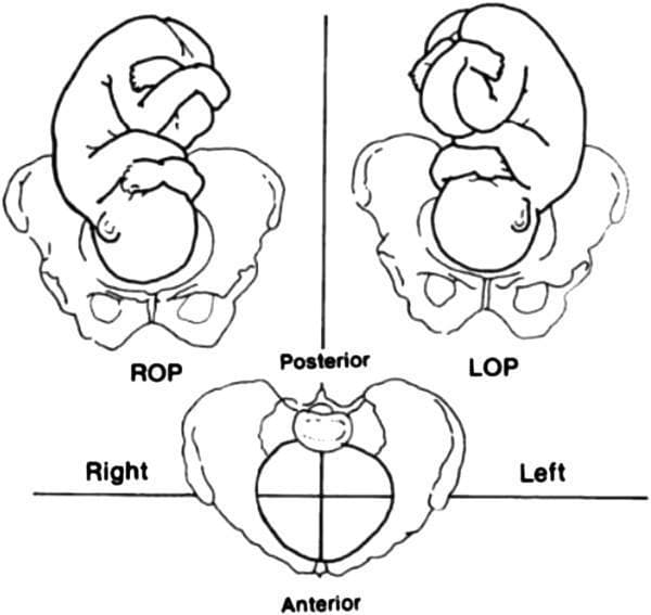 This medical anatomical diagram illustrates the various orientations of fetal occipitoposterior (OP) positions within the maternal pelvis during labour. The content is presented as three line-art diagrams from a superior perspective, focusing on the relationship between the fetal head and maternal pelvic landmarks (ilium, ischium, and sacrum). The top-left diagram shows the Right Occipito-Posterior (ROP) position, where the fetal occiput is directed toward the right posterior quadrant of the maternal pelvis. The top-right diagram depicts the Left Occipito-Posterior (LOP) position, with the occiput oriented toward the left posterior quadrant. The bottom center diagram illustrates the Occiput at Sacrum (OS) position, or Direct OP, where the occiput is positioned directly against the maternal sacrum. These diagrams demonstrate malpresentations where the fetal face is oriented anteriorly toward the maternal symphysis pubis. Educational objectives include the classification of fetal station and rotation, understanding the mechanisms of prolonged labour, and clinical management of malpositions in obstetrics.