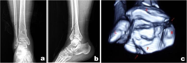 This composite figure displays diagnostic imaging of a pilon fracture (distal tibial fracture) in a 37-year-old male. Panels (a) and (b) are preoperative X-ray radiographs in anterior-posterior and lateral views, respectively. They reveal a complex, comminuted fracture of the right distal tibia and fibula with significant intra-articular involvement and visible displacement of bone fragments. Panel (c) is a 3D-reconstructed axial CT scan identifying key fracture components: a posterior malleolar fragment (P), a medial die-punch fragment (M), and an anterior fragment (A), alongside a lateral fragment (L). The imaging demonstrates a collapse of the articular surface and multi-planar disruption of the distal tibial plafond. Red arrows in the CT scan highlight areas of fragment displacement. These images illustrate the preoperative classification and mapping used to determine surgical approaches, such as posterolateral or anteromedial access, based on the spatial distribution of fragments relative to anatomical landmarks like the tarsal tunnel.