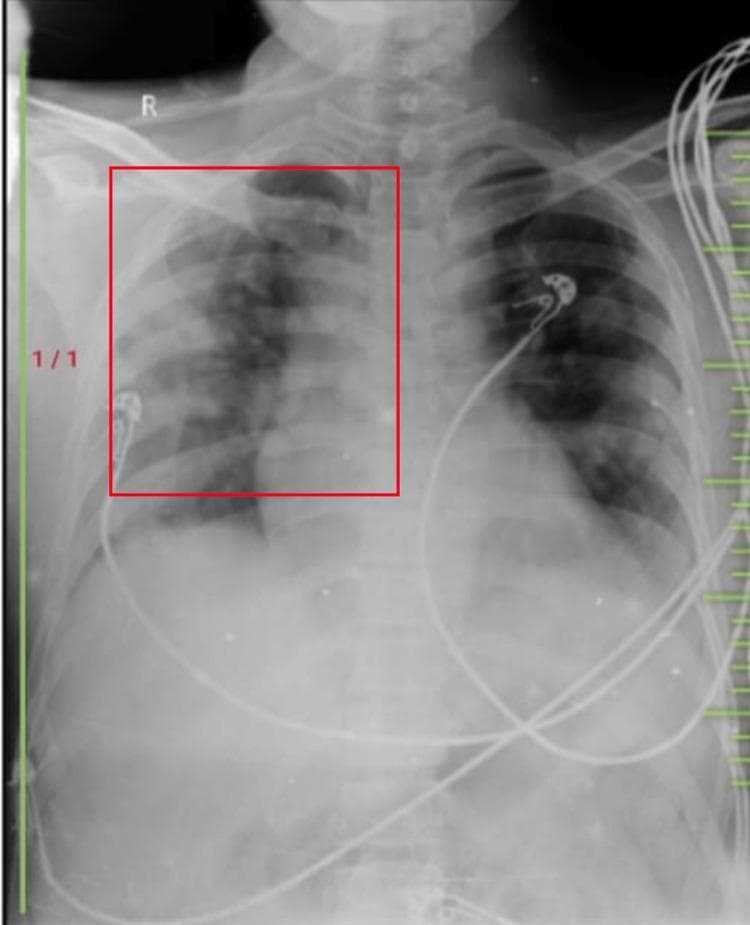 Diagnostic Imaging: This is a posteroanterior (PA) view chest X-ray demonstrating a clinical presentation of pulmonary hyper-translucency. The image captures the thoracic cavity with a red bounding box highlighting the right upper and middle lung zones. Distinctive visual features include increased radiolucency (hyper-translucency) across both lung fields, suggestive of pulmonary hyperinflation or increased air trapping. Despite the increased lucency, bronchovesicular markings remain visible throughout the parenchyma. A prominent hilar marking is identifiable on the right side within the highlighted region. Anatomical landmarks such as the clavicles, ribs, and cardiac silhouette are visible, though the diaphragm appears somewhat flattened, consistent with hyperinflation. Medical monitoring leads and cables are overlaid on the chest wall. This imaging is clinically significant for demonstrating radiographic signs of obstructive lung disease or other conditions involving alveolar over-distension, useful for students learning to identify variations in lung density and airway-related pathologies.