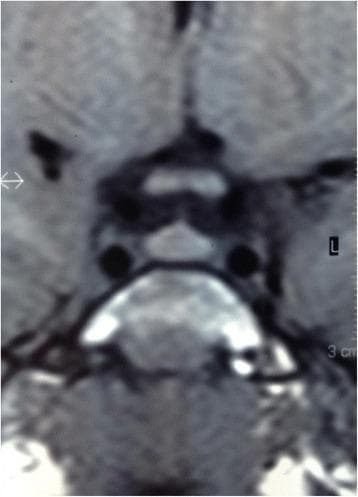 This diagnostic image consists of precontrast T1-weighted Magnetic Resonance Imaging (MRI) views of the sellar region. The visual focus is on the pituitary gland, depicted in both sagittal and coronal orientations. The gland demonstrates a homogeneous internal signal intensity with an enlarged vertical dimension and a prominent convex upper surface, which deviates from the typical flat or concave morphology. Within the sella turcica, the anterior lobe is clearly defined, and the posterior lobe displays its characteristic physiological T1-weighted hyperintensity (the 'pituitary bright spot'). The surrounding neuroanatomical structures, including the optic chiasm above the convex superior border and the adjacent cavernous sinuses, are visible. This imaging is clinically relevant for evaluating pituitary volume and morphology in the context of neuroendocrine disorders or pediatric growth abnormalities.