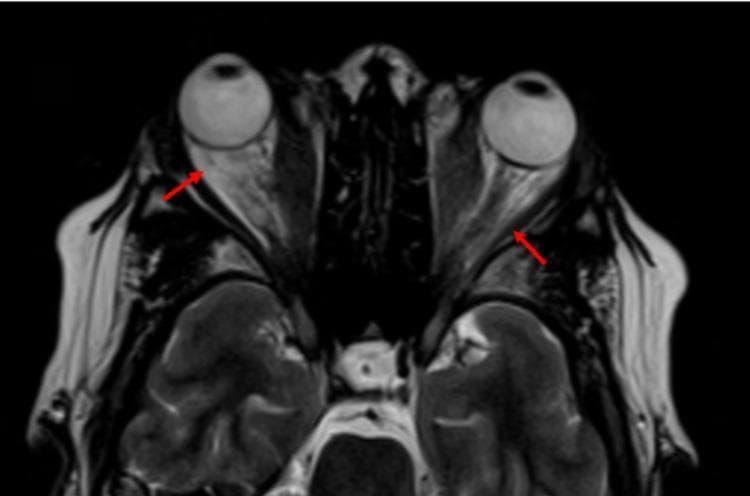 This diagnostic image is an axial MRI of the orbits demonstrating hallmark findings of thyroid eye disease (Graves' ophthalmopathy). The image reveals bilateral proptosis, characterized by the forward displacement of the globes beyond the anterior orbital rim. There is a significant increase in the volume of the retrobulbar orbital fat, indicated by red arrows, which appears hyperintense with a heterogeneous texture and subtle stranding, suggestive of inflammatory changes or edema. The extraocular muscles, specifically the medial recti, show moderate enlargement and appear to be encroaching upon the optic nerves bilaterally. The overall appearance highlights common pathophysiology in autoimmune orbital disease, where fat expansion and extraocular muscle hypertrophy contribute to increased intraorbital pressure and exophthalmos. This educational image is relevant for radiology and ophthalmology in diagnosing and assessing the severity of restrictive myopathy and orbital congestion.