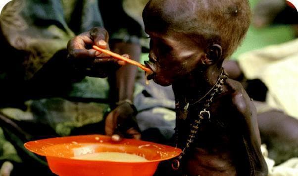 This clinical photograph illustrates severe pediatric malnutrition, likely marasmus, in a young child. The child exhibits profound emaciation characterized by a 'skin and bones' appearance, visible rib protrusion, and significant loss of subcutaneous fat and muscle mass. The skin is taut and the temporal region shows wasting. Thin, sparse hair is evident, which can be a sign of protein-energy malnutrition (PEM). An adult is seen providing nutritional support by spoon-feeding the child a light-colored, semi-liquid therapeutic porridge from a plastic bowl. This visual serves as an educational example of the physical manifestations of chronic calorie deficiency and global food insecurity. The image is relevant for medical studies in global health, pediatrics, and clinical nutrition, demonstrating the critical need for nutritional rehabilitation in severely malnourished populations.