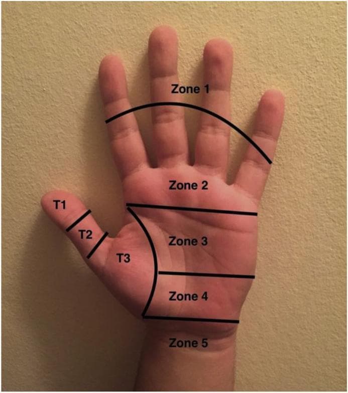 This clinical photograph displays the volar (palmar) surface of a human hand, annotated to illustrate the Verdan classification system for flexor tendon injury zones. The image serves as an educational anatomical diagram for hand surgery and trauma management. The hand is divided into five primary zones and three specific thumb zones (T1–T3) using black demarcation lines. Zone 1 covers the distal segments of the fingers; Zone 2 (often called 'No Man's Land') extends from the distal palmar crease to the mid-portion of the middle phalanges; Zone 3 encompasses the central palm (lumbrical origin); Zone 4 corresponds to the carpal tunnel region; and Zone 5 includes the area proximal to the wrist crease (forearm). The thumb is separately classified into T1 (distal to the IP joint), T2 (between the MCP and IP joints), and T3 (thenar eminence). This visual guide is essential for medical students and surgical residents to understand the prognosis and surgical approach for flexor tendon repairs based on the anatomical site of injury.