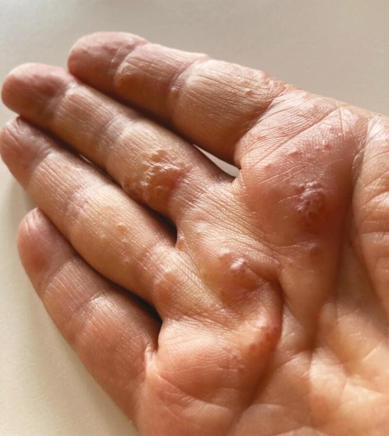 Clinical photograph of a right hand, specifically the palmar surface and digits, displaying dyshidrotic eczema (pompholyx). The image shows multiple deep-seated, small, tense vesicles and papules distributed across the palm, thenar eminence, and lateral aspects of the fingers. The lesions exhibit varying morphology, including clear fluid-filled vesicles and larger inflammatory papular clusters with a background of diffuse erythema. There is a notable absence of significant scaling or crusting, indicating an acute to subacute presentation. The skin appears mildly edematous with accentuated skin markings. Clinically, this visual represents a Grade 3 cutaneous adverse event (CAE) related to ribociclib therapy, illustrating a drug-induced eczematous dermatitis. Key educational concepts include the recognition of pompholyx-like distributions in the context of oncology-related dermatological toxicity and the identification of inflammatory vesiculobullous eruptions on acral surfaces.