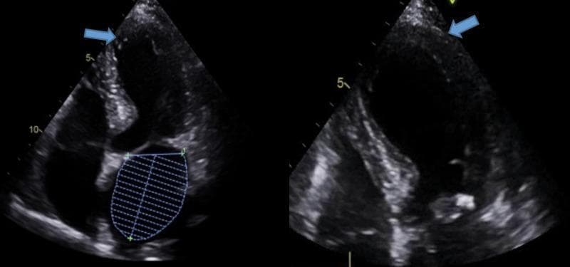 Two diagnostic images consisting of an apical four-chamber (A4C) view echocardiogram demonstrating the classic visual features of Takotsubo Cardiomyopathy (TTCM), also known as Stress-Induced Cardiomyopathy. The primary finding is apical ballooning of the left ventricle (LV), characterized by a distinctive rounded, bulbous appearance of the apex compared to the narrower basal segments. Blue arrows in both the standard and magnified views point to the apical region, highlighting apical hypokinesia and akinesia, where the myocardial wall exhibits reduced or absent inward movement during systole. The contrast between the hyperdynamic basal contraction and the akinetic, 'ballooned' apex is a hallmark of this condition. The image on the left includes a volumetric trace of the left atrium, while the image on the right provides a detailed, expanded view of the LV apical pathology. This echocardiographic finding is essential for differentiating stress-induced cardiomyopathy from obstructive coronary artery disease in clinical practice.