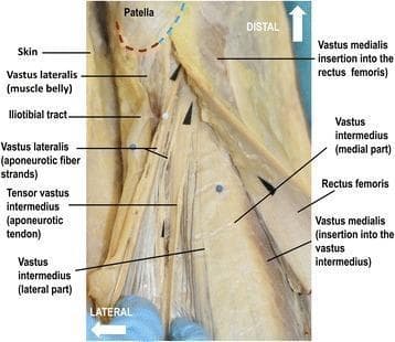 This clinical photograph displays a macro-dissection of the distal human extensor apparatus of the knee, highlighting the complex multi-layered architecture of the quadriceps muscle group. The image identifies the muscle bellies and aponeurotic insertions of the vastus lateralis, vastus medialis, rectus femoris, and vastus intermedius. Notably, it demonstrates the tensor vastus intermedius and its aponeurotic tendon, characterizing the five-component model of the quadriceps. The rectus femoris is medially reflected to reveal the insertion of the vastus medialis into both the rectus femoris and the vastus intermedius. The vastus lateralis shows distinct aponeurotic fiber strands and a strong muscle belly inserting at the supero-lateral semi-circle of the patella (indicated by a red dotted line). In contrast, the vastus medialis occupies the supero-medial half of the patella's upper semi-circle (indicated by a blue dotted line). Fiber orientations for the lateral components are directed toward the medial femoral condyle, illustrating the dynamic balance required for patellar tracking and knee extension stability.