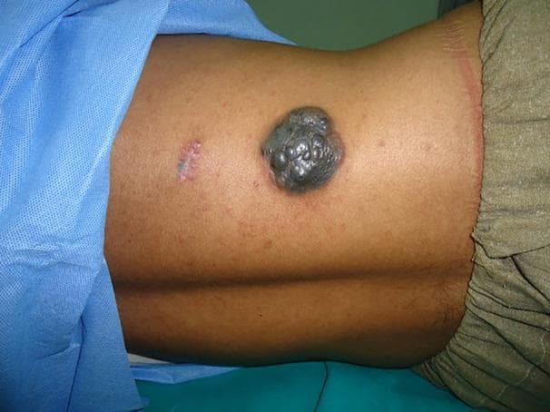 Clinical photograph of a 33-year-old male's trunk displaying a large, exophytic nodular melanoma located on the right dorsal aspect. The primary lesion is a heavily pigmented, multi-lobulated mass that appears charcoal-black to dark gray with a distinctive 'bunch of grapes' morphology. Its surface is irregular and demonstrates a glistening sheen. Adjacent to this primary mass is a smaller, horizontal, erythematous linear scar, possibly indicating a prior biopsy or minor surgical site. The background skin shows mild perifollicular erythema and a few scattered benign-appearing nevi. This image serves as a textbook example of advanced nodular melanoma, emphasizing the importance of identifying rapidly growing, pigmented, and elevated skin lesions in dermatological oncology. The presentation is contextually linked to high-stage (III or IV) disease management in adult patients.