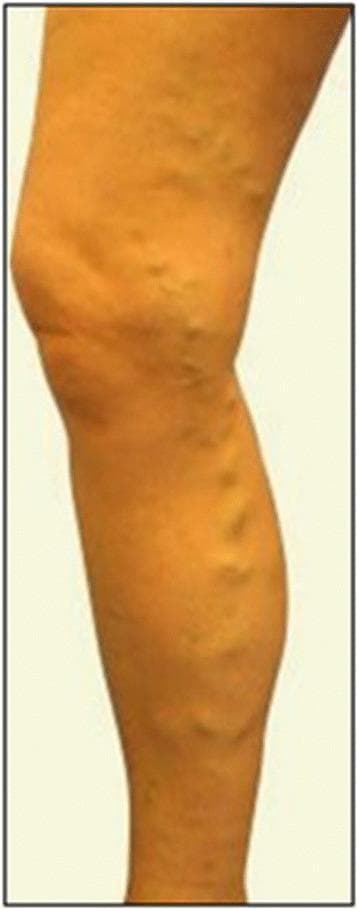 This clinical photograph displays a lateral view of a right lower limb exhibiting varicose syndrome. The image demonstrates significant venous insufficiency characterized by prominent, dilated, and tortuous superficial veins. These enlarged vessels are particularly visible along the posterior and medial aspects of the calf and around the knee joint. The veins appear as irregular, bulging, rope-like elevations beneath the skin surface. The skin over the affected areas shows mild distention due to the underlying venous pressure, but there are no overt signs of chronic venous stasis such as hyperpigmentation, stasis dermatitis, or ulceration in this specific view. The anatomical distribution is consistent with involvement of the saphenous system. This visual represents a classic presentation of severe varicose veins, which clinically correlates with symptoms like heaviness, pain, or edema, and often serves as a preoperative baseline for surgical interventions such as saphenectomy or vein stripping.