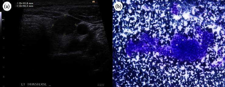 This dual-panel image displays diagnostic findings for thyroid pathology, combining ultrasonography and cytology. (a) A transverse thyroid ultrasound image reveals a localized, solid, hypoechoic nodule in the left lobe. The lesion is characterized by a wider-than-tall orientation and well-defined, smooth margins without internal calcifications. Caliper measurements indicate the nodule size is approximately 11.8 mm x 10.2 mm. (b) A corresponding cytological smear from fine-needle aspiration (FNA) shows a highly cellular specimen with densely packed clusters. The predominant cellular morphology includes spindle-shaped and tall cells with elongated nuclei and an increased nucleus-to-cytoplasm (N:C) ratio, characteristic of papillary growth patterns. Together, these images illustrate the diagnostic workup for thyroid cancer, specifically highlighting features that led to a Bethesda category VI classification and the eventual diagnosis of cribriform-morular thyroid carcinoma. This content is intended for intermediate to advanced medical learners studying endocrinology, radiology, and pathology.