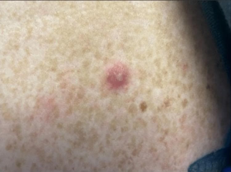 Clinical photograph of a characteristic vesiculopustular skin lesion associated with disseminated gonococcal infection (DGI). The primary lesion is a solitary, erythematous papule, approximately 3-5 mm in diameter, with a centralized greyish-white pustule/vesicle and a dusky, necrotic appearance at the core. The surrounding skin shows generalized solar lentigines (freckling) but no acute inflammatory changes. This visual finding is a hallmark of the arthritis-dermatitis syndrome seen in Neisseria gonorrhoeae dissemination, typically presenting as sparse, painless, non-pruritic lesions on distal extremities. This image serves as an educational reference for identifying cutaneous manifestations of systemic sexually transmitted infections in a clinical setting.