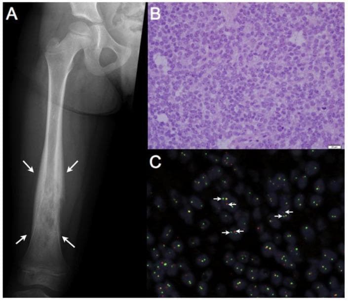 This composite educational image illustrates the multimodal diagnostic features of Ewing sarcoma, a malignant primary bone tumor. Panel A displays an anteroposterior X-ray of a pediatric femur showing an expansile, permeative, and destructive lesion within the diaphysis, marked by white arrows. Panel B provides a histopathological view (H&E stain, 400x magnification) revealing a dense proliferation of monomorphic 'small round blue cells' characterized by high nuclear-to-cytoplasmic ratios and scanty cytoplasm, arranged in sheets. Panel C demonstrates a break-apart Fluorescence in situ Hybridization (FISH) assay used for molecular confirmation. The presence of separated red (5'-EWSR1) and green (3'-EWSR1) fluorescent signals (white arrows) indicates a chromosomal rearrangement of the EWSR1 locus on chromosome 22, while fused orange signals represent intact alleles. This progression from gross radiology to cellular morphology and molecular genetics highlights the integrated diagnostic approach required for bone sarcomas in children and young adults.