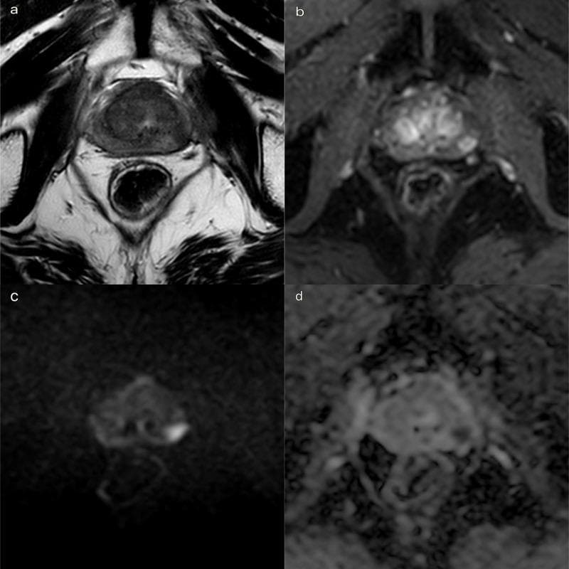Multiparametric MRI (mpMRI) of the prostate in the axial plane demonstrating a focal recurrence of prostate cancer in the left peripheral zone. Panel (a) is a T2-weighted Turbo Spin Echo (TSE) image showing an 18mm hypointense lesion in the mid-portion of the left peripheral zone with a curvilinear contact surface along the capsule, though no frank extracapsular extension is visible. Panel (b) illustrates Dynamic Contrast-Enhanced (DCE) imaging using a T1-weighted Dixon sequence with fat suppression, revealing early focal arterial enhancement in the same region. Panels (c) and (d) show Diffusion-Weighted Imaging (DWI) at a high b-value of 2500 s/mm² and the corresponding Apparent Diffusion Coefficient (ADC) map, respectively. The lesion exhibits marked hyperintensity on the high b-value DWI and corresponding hypointensity on the ADC map, indicating restricted diffusion and high cellularity characteristic of a PI-RR score of 4. This diagnostic series is used for staging local recurrence and planning targeted biopsy or focal therapy.