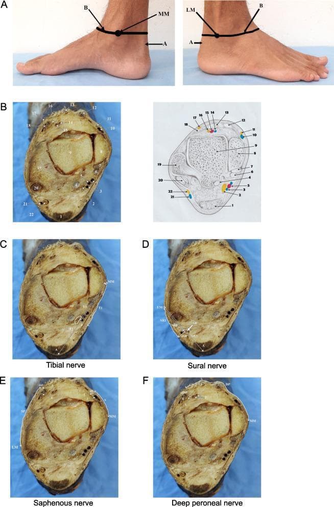 This composite educational resource illustrates the anatomical landmarks and cross-sectional morphology relevant for performing an ankle nerve block. Panel A shows clinical photographs of the medial and lateral ankle with surface markings at the level of the malleoli. Panel B provides a cadaveric cross-section and a corresponding labeled anatomical diagram at the inter-malleolar plane. Key visible structures include the talus (9), Achilles tendon (1), medial (8) and lateral (19) malleoli, and associated neurovascular bundles. Subsequent panels (C-F) map specific regional anesthesia targets: the tibial nerve (C) located posteromedial to the Achilles tendon; the sural nerve (D) located between the lateral malleolus and Achilles; the saphenous and medial dorsal cutaneous nerves (E) along the anterior-medial aspect; and the deep peroneal nerve (F) situated anteriorly between the extensor tendons. Measurements (T1-T3, SR1-SR3, DP) denote distances from palpable bony landmarks to the nerves and depth from the skin surface (dT, dSR, dDP). This content is intended for advanced clinical learners in anesthesiology and orthopedic surgery to understand the spatial relationships required for ultrasound-guided or landmark-based regional anesthesia.