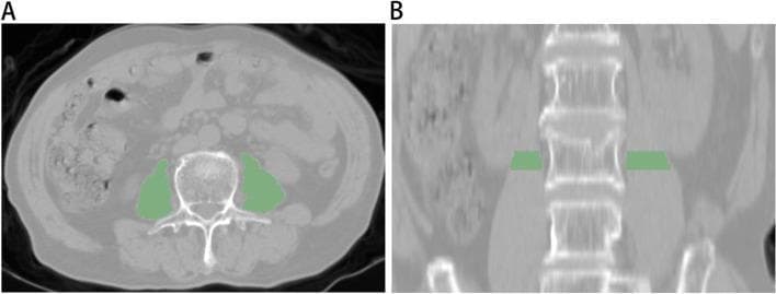 This diagnostic image demonstrates the segmentation of the psoas major muscle using unenhanced abdominal computed tomography (CT) at the level of the third lumbar vertebra (L3). Image A presents a transverse (axial) view showing the cross-sectional area of the bilateral psoas muscles highlighted in green. The muscles are situated posterolaterally to the centrally located vertebral body and anterior to the transverse processes. Visible surrounding anatomy includes the spinal canal, abdominal wall, and intra-abdominal viscera. Image B shows a coronal reconstruction of the same region, with the green-shaded regions indicating the vertical orientation of the psoas muscle segments adjacent to the L3 vertebral body. The lumbar spine is centrally aligned, with the kidneys visible laterally in the retroperitoneal space. This visualization is characteristic of sarcopenia or osteoporosis research, where psoas muscle mass and radiomic features are analyzed as biomarkers for musculoskeletal health and systemic frailty.