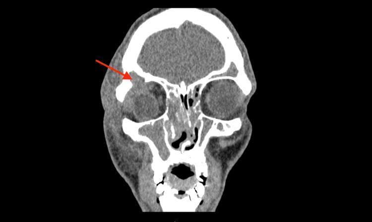 This diagnostic image is a coronal Computed Tomography (CT) scan of the head, presented in a soft tissue window. It illustrates a frontal sinus mucocele with orbital extension. Key features include a homogenous soft tissue density mass originating from the opacified right frontal sinus and herniating through a bony defect in the superolateral orbital roof, indicated by a red arrow. This mass causes inferior and medial displacement of the right globe and extraocular muscles. Additionally, there is evidence of diffuse periorbital soft tissue swelling and complete opacification of the bilateral ethmoid and maxillary sinuses. The image serves as a clinical example of sinus pathology complications, specifically highlighting the erosion of the orbital wall and the resulting mechanical effect on orbital contents. It is relevant for medical education regarding otorhinolaryngology, ophthalmology, and radiology, demonstrating the diagnostic utility of CT in assessing chronic sinusitis and its extrasinus manifestations.