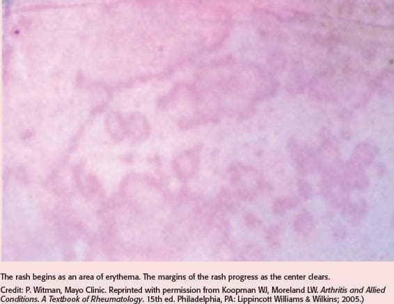 This clinical photograph displays a dermatological manifestation of erythema marginatum, a hallmark cutaneous sign of acute rheumatic fever. The image reveals multiple pinkish-red, erythematous lesions characterized by a distinct annular and serpiginous configuration. Key visual features include a vibrant, well-defined advancing periphery with significant central clearing, where the skin returns to a paler or near-normal hue. The rash appears non-pruritic and non-elevated, typically found on the trunk and proximal extremities. This visual serves as a primary diagnostic indicator for clinicians identifying systemic inflammatory conditions following a Group A streptococcal infection. The morphology demonstrates the classic 'smoke ring' appearance associated with this evanescent rash, emphasizing its migratory nature and peripheral progression.