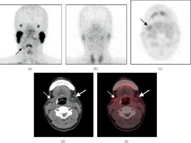 Comparison of salivary gland imaging using 68Ga-PSMA-11 PET/CT and 99mTcO4− salivary gland scintigraphy (SGS) in a 64-year-old male with post-radiotherapy nasopharyngeal carcinoma. Panel (a) shows a Maximum Intensity Projection (MIP) image where a slight tracer uptake is noted in the right submandibular gland (small arrow, SUVmax 2.6). Panel (b) depicts planar SGS with absent tracer uptake in bilateral submandibular glands, indicating severe functional impairment. Panels (c-e) provide tomographic axial views (PET, CT, and fused PET/CT) illustrating morphological and functional asymmetry. There is a significant reduction in the volume (atrophy) of the left submandibular gland (large arrow, SUVmax 1.9) compared to the right. The diagnostic images demonstrate the superior sensitivity and anatomical resolution of 68Ga-PSMA-11 PET/CT over SGS in evaluating glandular atrophy and residual functional metabolic activity in salivary glands following radiotherapy.