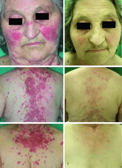 This composite clinical photograph series illustrates the progression of drug-induced subacute cutaneous lupus erythematosus (SCLE) in a 70-year-old female. Images (a-c) demonstrate the baseline presentation: (a) shows a prominent, symmetric, bright red malar erythema across the cheeks and bridge of the nose, characteristic of a 'butterfly rash'; (b) and (c) display extensive macular erythematous lesions on the upper back, chest, and arms, with some lesions exhibiting an annular or polycyclic morphology. These lesions are well-demarcated, non-scarring, and primarily distributed in sun-exposed areas. Images (d-f) show the clinical outcome one month following the discontinuation of the offending agent (hydrochlorothiazide) and treatment with low-dose systemic steroids. There is a marked reduction in the intensity and distribution of the erythema; the malar rash has significantly faded, and the truncal macular lesions have diminished to faint, sparse pigmented patches. This comparison serves as an educational tool for identifying photosensitive drug-induced cutaneous reactions and monitoring clinical response to drug withdrawal and corticosteroid therapy.