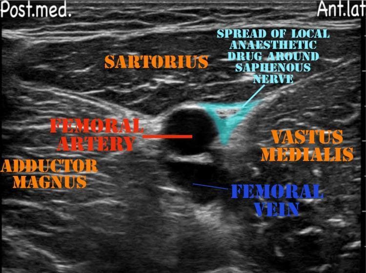 This diagnostic ultrasound image demonstrates the regional anatomy and needle-guided local anesthetic spread for an adductor canal block. The transverse view shows the sartorius muscle located superiorly (superficially) to the neurovascular bundle. Deep to the sartorius, the femoral artery appears as a prominent anechoic circular structure, with the femoral vein positioned deeper and slightly posterior. The vastus medialis muscle forms the lateral boundary, while the adductor magnus is visible in the posterior-medial aspect. A key clinical feature is the highlighted hypoechoic region representing the local anesthetic drug spread around the saphenous nerve, located in the subsartorial space (adductor canal) adjacent to the femoral artery and vastus medialis. Orientation markers indicate the posterior-medial ('Post.med.') and anterior-lateral ('Ant.lat.') axes. This visual serves as a pedagogical tool for anesthesiology and pain management, illustrating proper drug deposition to achieve sensory blockade of the medial thigh and knee while sparing motor function.