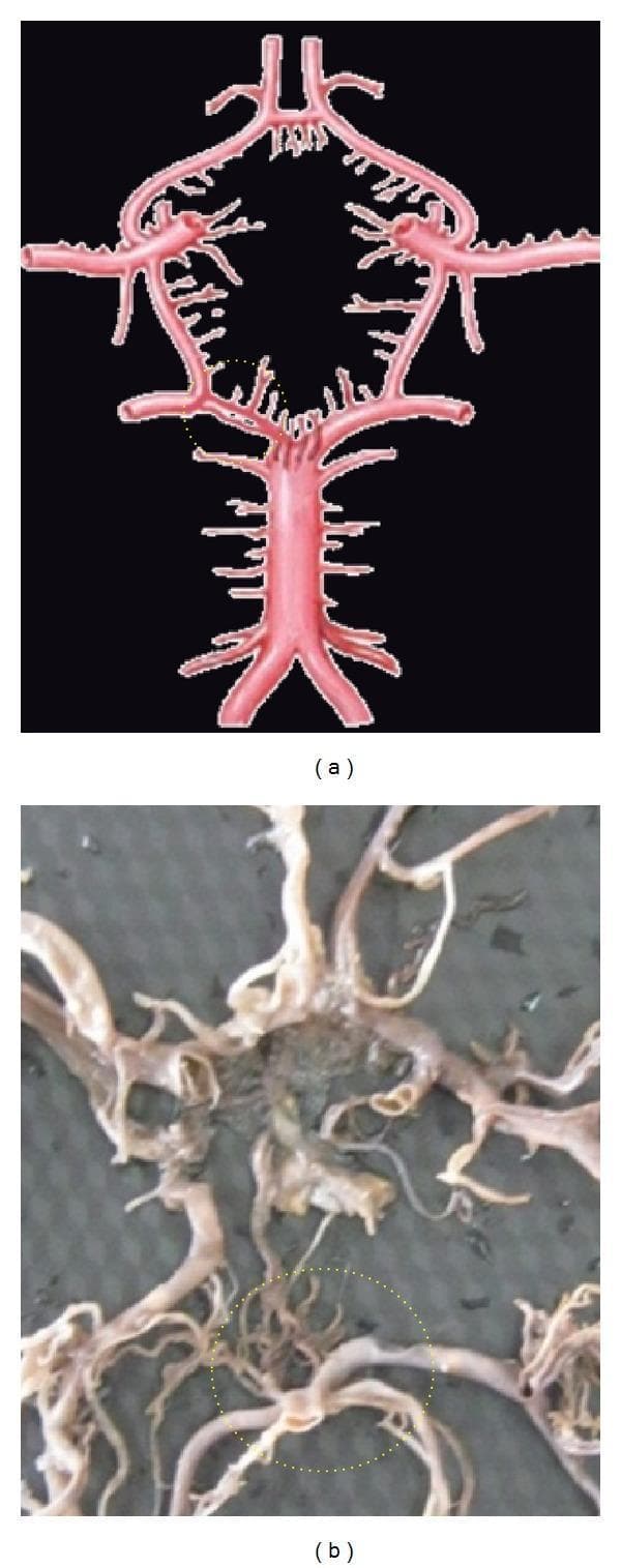 The image consists of two panels (a and b) illustrating the anatomy of the Circle of Willis at the base of the brain. Panel (a) is an anatomical diagram showing a standard arterial configuration with a dotted yellow circle highlighting the junction of the basilar artery and the posterior cerebral artery (PCA). Panel (b) is a clinical photograph of a post-mortem anatomical specimen showing the cerebral vasculature. A dotted yellow circle in panel (b) highlights a vascular anomaly: a duplication of the P1 segment of the posterior cerebral artery. In this region, the arterial pathway consists of two parallel, distinct vascular channels rather than a single vessel. The broader anatomical context displays the basilar artery, internal carotid arteries (ICA), anterior cerebral arteries (ACA), and communicating arteries (ACoA and PCoA). The image is intended for medical education in neuroanatomy and neuroradiology to demonstrate normal anatomical variants and congenital anomalies of the cerebral collateral circulation.