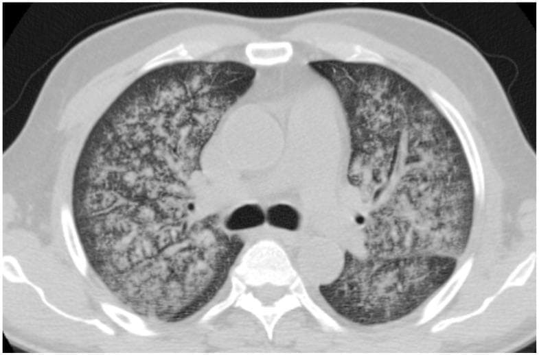 This diagnostic axial CT scan of the chest reveals diffuse bilateral lung parenchymal abnormalities in a patient with Granulomatosis with Polyangiitis (GPA). The primary imaging finding is a widespread ground-glass opacity (GGO) pattern, characterized by a hazy increase in lung attenuation that does not obscure underlying vascular structures. The distribution is predominantly central and perihilar, with notable relative sparing of the subpleural regions. Superimposed on the ground-glass opacities, there is evidence of subtle reticular thickening, suggesting interlobular septal involvement, though distinct consolidations or large pulmonary nodules are absent in this slice. Despite the extensive parenchymal involvement, lung volumes appear preserved. These findings are clinically representative of diffuse alveolar hemorrhage (DAH) secondary to pulmonary vasculitis (hemorrhagic alveolitis). The image serves as a high-yield educational example of the thoracic manifestations of ANCA-associated vasculitides for radiology and rheumatology residents.
