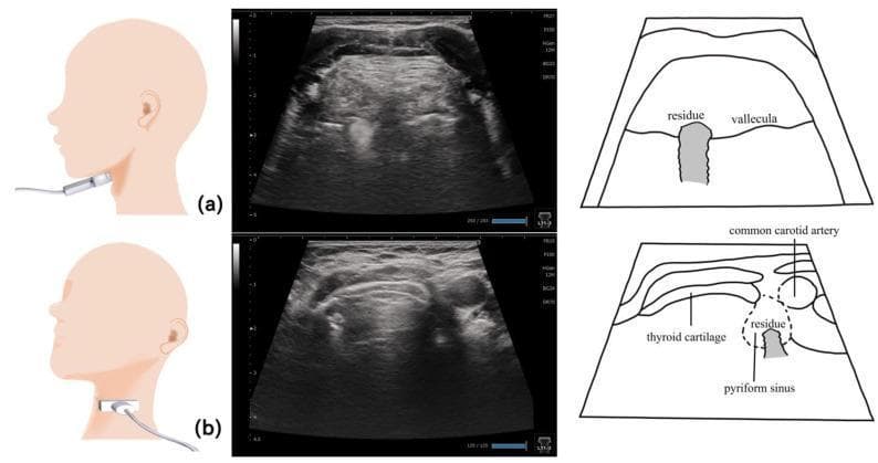 This composite educational image illustrates the use of ultrasonography for evaluating pharyngeal residue in patients with dysphagia. It is divided into two sections, (a) and (b), each featuring a probe placement diagram, a transverse ultrasound scan, and a corresponding labeled schematic. Row (a) demonstrates the visualization of the epiglottic vallecula. The probe is positioned submentally at the level of the hyoid bone. The ultrasound reveals a distinct hyperechoic area within the vallecular space, indicating food or liquid residue. Row (b) illustrates the assessment of the pyriform sinus. The probe is placed lower on the lateral neck at the level of the laryngeal prominence. Key anatomical landmarks include the thyroid cartilage and the common carotid artery, which serve as orientation points for the pyriform sinus. In this view, a smaller hyperechoic residue is visible within the sinus. This diagnostic imaging modality provides a non-invasive method for detecting post-swallow residue, aiding in the clinical management of swallowing disorders.