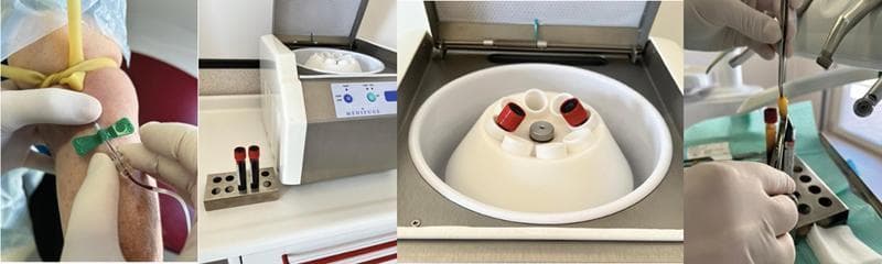 A multi-panel clinical photograph series demonstrating the workflow for preparing Concentrated Growth Factor (CGF). The sequence begins with peripheral venous blood collection from a patient’s arm using a butterfly needle and tourniquet. Collected blood is contained in red-stoppered tubes, which are then placed into a specialized benchtop centrifuge (Medifuge MF200). An overhead view shows the centrifuge rotor loaded with tubes for automated separation of blood components. Following centrifugation, the final panel illustrates the manual extraction and manipulation of the fibrin-rich CGF clot using sterile surgical forceps. The CGF appears as a dense, yellowish-orange autologous biomaterial. This process is used in regenerative medicine, specifically dental and oral surgery, to produce growth factor-rich membranes for bone defect repair and tissue regeneration. The images highlight the transition from whole blood collection to the isolation of the growth factor and stem cell layer through density-based separation.