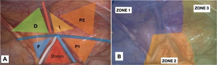 This composite intraoperative clinical photograph illustrates the surgical anatomy of the posterior inguinal region during a laparoscopic hernia repair. Image A displays essential anatomical landmarks and triangles: a green triangle (D) representing the direct hernia area; a yellow triangle (I) for the indirect hernia area; a blue triangle (F) for the femoral hernia area; and the red 'Triangle of Doom' containing the external iliac vessels. Two orange regions (P1 and P2) designate 'Triangles of Pain,' with P2 highlighting a revised superior boundary (2 cm above the iliopubic tract) to account for variations in nerve branches (lateral cutaneous nerve of the thigh and genitofemoral nerve). Image B divides the surgical field into three zones for procedural standardization: Zone 1 (medial/inferior) focusing on Cooper's ligament and epigastric vessels, Zone 2 (central) involving the spermatic cord and vas deferens parietalization, and Zone 3 (lateral) encompassing the pain triangles. The images demonstrate the preperitoneal view necessary for TAPP/TEP procedures, emphasizing safe zones for mesh fixation to avoid neurovascular injury.