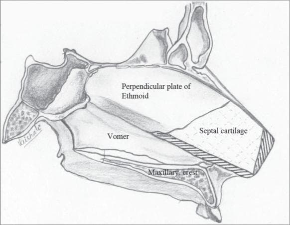 This medical anatomical diagram illustrates the surgical anatomy of the nasal septum, specifically focusing on modifications made during septal correction in cleft lip rhinoplasty. The diagram depicts the septal cartilage in its anatomical relationship to the perpendicular plate of the ethmoid (superior-posterior), the vomer (inferior-posterior), and the maxillary crest (inferior). The septal cartilage is shown as a quadrangular structure with surgical alterations: cross-hatched shading along the inferior and anterior borders represents slivers of excised cartilage to prevent buckling and enhance nasal tip projection. Additionally, the main body of the cartilage features fine vertical scoring lines on its concave (non-cleft) surface, a technique used to nullify the bow-string effect and achieve a flail, midline-correctable state. The illustration serves as a guide for reconstructive surgeons to understand the resection sites and cartilage weakening maneuvers necessary to correct septal deviation and improve nasal symmetry in pediatric or adult cleft patients.