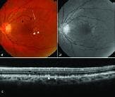 This multimodal diagnostic image set illustrates the clinical features of Age-related Macular Degeneration (AMD) through fundus photography, red-free imaging, and Spectral-Domain Optical Coherence Tomography (SD-OCT). The color fundus photograph displays yellowish-white soft drusen at the fovea with scattered dot-like subretinal drusenoid deposits (SDD) in the perifoveal region. The red-free image provides enhanced contrast, more clearly delineating the SDD against the retinal background compared to the soft drusen. The cross-sectional SD-OCT scan reveals specific morphological differences: soft drusen appear as smooth, dome-shaped elevations beneath the retinal pigment epithelium (RPE), whereas SDDs are identified as sharp, peaked, hyperreflective lesions located above the RPE (subretinal space), specifically disrupting the ellipsoid zone. This comparison highlights the importance of multimodal imaging in distinguishing between classical drusen and subretinal drusenoid deposits, which are critical markers in monitoring the progression of macular pathology.
