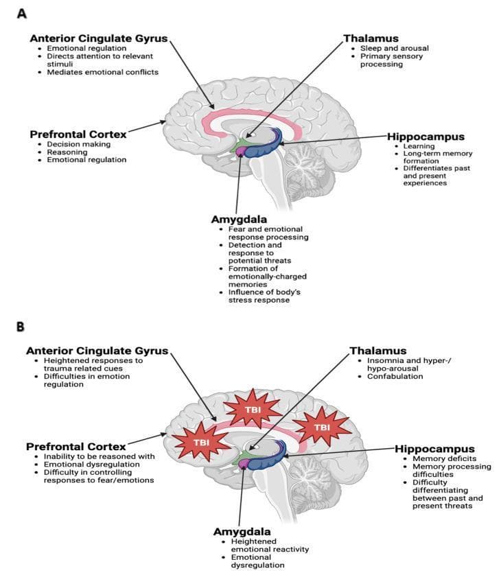 Educational comparison diagram illustrating the functional anatomy of the limbic system in health and post-traumatic brain injury (TBI). Part A (Normal State) displays a sagittal cross-section of the human brain, identifying five key structures: the anterior cingulate gyrus (emotional regulation, attention), prefrontal cortex (decision-making, reasoning), amygdala (fear processing, threat detection), thalamus (sleep, arousal), and hippocampus (learning, long-term memory). Each structure is color-coded and spatially mapped within the medial cerebrum. Part B (Post-TBI State) utilizes the same anatomical template but includes red 'TBI' impact icons localized to the frontal and parietal regions. This section details pathological functional changes, such as emotional dysregulation in the prefrontal cortex and amygdala, heightened trauma responses in the anterior cingulate gyrus, sleep disturbances (insomnia) in the thalamus, and memory deficits or threat differentiation difficulties in the hippocampus. The diagram serves as a clinical education tool to explain the pathophysiology of neuropsychiatric sequelae, such as PTSD, following physical or psychological trauma.