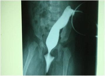 This diagnostic image is a contrast-enhanced colostogram (X-ray radiography) of a pediatric patient, likely an infant, focused on the lower abdomen and pelvic region. The imaging shows a gastrografin contrast medium introduced through a sigmoid colostomy site, filling the distal colon. The radiopaque contrast clearly delineates a blind-ending rectal pouch, characteristic of anorectal malformation (imperforate anus). Crucially, a thin, fistulous tract is visible extending inferiorly from the rectal pouch and terminating at the vulval vestibule, confirming a rectovestibular fistula. The surrounding skeletal anatomy reveals the lumbar spine, pelvic bones, and proximal femurs, which serve as landmarks to assess the level of the rectal pouch relative to the puborectalis muscle and pelvic floor. This image is medically significant for pediatric surgery and gastroenterology, as it demonstrates the morphology of high/intermediate anorectal malformations and guides posterior sagittal anorectoplasty (PSARP) planning.