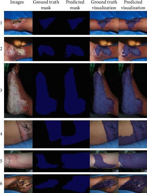 This clinical dataset collage demonstrates the application of deep learning for burn wound segmentation. The image is structured in a 6x5 grid. The first column displays clinical photographs of various burn injuries on human limbs, showing a spectrum of wound morphology: superficial redness, blistering, deep partial-thickness wounds with white/pink slough, and full-thickness burns characterized by charred eschar and exposed subcutaneous tissue. The second and third columns present 'Ground truth mask' and 'Predicted mask' as binary blue-on-black segmentations, representing expert labels versus AI-generated area detections. The fourth and fifth columns, 'Ground truth visualization' and 'Predicted visualization,' show these masks overlaid as semi-transparent blue filters on the original clinical images to illustrate the accuracy of the automated segmentation. The examples highlight the challenges in defining burn boundaries, especially in cases with transitional zones between burned and healthy skin. This material is designed for medical informatics and dermatology education, focusing on automated diagnostic imaging and the assessment of burn surface area and depth.