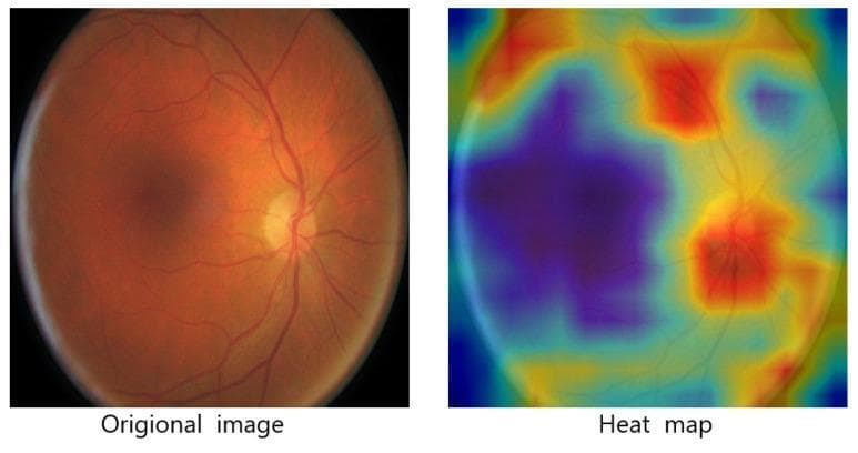 This figure presents a comparative visualization of a retinal fundus photograph (left) and its corresponding attention-based heat map (right), used in the diagnostic assessment of diabetic retinopathy. The clinical photograph displays a standard posterior pole view of the human retina, characterized by an orange-red fundus, a centrally located dark foveal region, and a distinct, pale optic disc with radiating primary retinal vasculature. The heat map on the right illustrates the spatial focus of a deep learning model's attention mechanism. Using a color gradient where red indicates high intensity and blue indicates low intensity, the map demonstrates that the model prioritizes specific anatomical and pathological landmarks, such as the optic nerve head, major vascular branches, and the macula, for feature extraction and disease grading. This visualization serves an educational purpose by demonstrating how artificial intelligence identifies clinically relevant regions—potentially containing microaneurysms or exudates—to assist in the automated screening and classification of diabetic retinal lesions.
