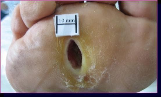 This clinical photograph displays a diabetic neuropathic foot ulcer located on the plantar surface of the third intermetatarsal space. The lesion is oval-shaped with a deep, crater-like morphology. The ulcer bed exhibits dark red granulation tissue, while the surrounding wound margins show a thick ring of yellowish, hyperkeratotic callous tissue typical of neuropathic pressure ulcers. The surrounding skin appears dry with evidence of scaling, consistent with diabetic xerosis. A white 10 mm scale marker is positioned superior to the lesion to provide a quantitative measurement reference. This image is used to demonstrate the baseline state of a chronic, non-ischemic diabetic foot ulcer prior to therapeutic intervention, such as extracorporeal shock wave therapy (ESWT). Key educational concepts include wound morphology, the role of pressure-induced hyperkeratosis in neuropathic ulcers, and clinical documentation of diabetic foot complications.