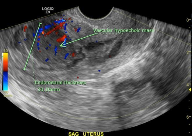This diagnostic image is a transvaginal ultrasound of the uterus in the sagittal plane, featuring both gray-scale and color Doppler imaging. The uterine view reveals a markedly thickened endometrial stripe measuring approximately 30.18 mm, which is significantly above the normal postmenopausal range. The endometrial contour is irregular and is partially delineated by a trace amount of intrauterine fluid. Within the anterior endometrium, there is a distinct ovoid, homogeneous, hypoechoic mass measuring roughly 3.2 x 2.2 cm. Color Doppler overlay demonstrates internal vascularity within this mass, indicated by red and blue flow signals. Such findings are clinically significant in the context of postmenopausal bleeding, as they necessitate differentiation between endometrial carcinoma, polyps, or rarer entities like primary uterine lymphoma. The image illustrates key sonographic markers for endometrial pathology evaluation including thickness measurement, echogenicity of focal lesions, and assessment of vascular flow patterns.