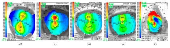 This composite diagnostic image displays five axial corneal topography maps, labeled C0, C1, C2, C3, and E4, obtained using a Nidek OPD Scan. Each map represents a color-coded axial curvature scale (in Diopters) to evaluate corneal power and shape regularity, often utilized in diagnosing Dry Eye Disease (DED) or keratoconus.
Images C0 through C3 demonstrate relatively organized patterns: C0 shows a round/oval steep central area (warmer colors like yellow/orange); C1 and C2 exhibit symmetric 'bow tie' astigmatic patterns; and C3 shows a moderate central steepness with organized peripheral flattening (cooler blue tones).
In contrast, image E4 represents severe surface irregularity (Grade 4). It displays a highly asymmetric and chaotic distribution of steepness (indicated by intense red/orange patches) and flattening (dark blue), signifying significant corneal surface distortion and high-order aberrations. These maps serve as educational visual aids for clinical grading of corneal surface health and regularity in response to therapeutic interventions.