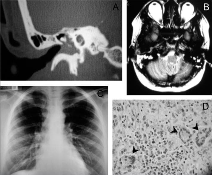 A multi-panel clinical figure presenting diagnostic findings for granulomatosis with polyangiitis (Wegener's). Panel A is a right-side temporal bone CT scan showing opacification or blurring of the tympanic cavity and mastoid air cells, suggesting inflammatory involvement. Panel B shows a T2-weighted axial skull MRI with a hyperintense signal in the right mastoid region, confirming fluid or soft tissue replacement of normal aeration. Panel C is a posterior-anterior chest X-ray demonstrating bilateral reticulonodular infiltrates, predominantly distributed in the lung bases. Panel D is a high-power histopathology micrograph (H&E stain) showing non-caseating granulomas, marked by arrows, characterized by localized clusters of epithelioid histiocytes and multinucleated giant cells within a background of dense inflammatory cell infiltration. Collectively, these images illustrate the multi-systemic nature of ANCA-associated vasculitis, involving the upper respiratory tract (ear/mastoid), lower respiratory tract (lungs), and microscopic tissue changes.