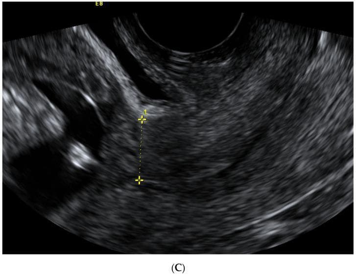 A transvaginal sagittal ultrasound image of the lower uterine segment in a first-trimester pregnancy. The myometrium exhibits a relatively homogenous, mid-gray echogenicity. Centered in the field is a caliper measurement (indicated by two yellow plus signs and a dashed line) used to assess the thickness of the isthmus uteri at the level of the internal cervical os. This image demonstrates a 'non-visible' Cesarean section (CS) scar, characterized by the absence of a distinct hypoechoic niche, indentation, or tissue defect at the site of the previous surgical incision. The anatomical relationship between the anterior uterine wall and the neighboring bladder (visible as a darker, hypoechoic space superiorly) is depicted. This diagnostic imaging serves as a clinical reference for evaluating uterine wall integrity and scar healing in patients with a history of prior Cesarean sections.
