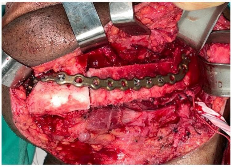 This intraoperative clinical photograph captures a surgical field during a complex maxillofacial reconstruction. The image shows a microvascularized fibula bone flap being used to reconstruct a mandibular defect following tumor resection for ameloblastoma. A contoured metallic reconstruction plate is secured across the osteotomized bone segments with multiple surgical screws, providing rigid internal fixation and maintaining the anatomical contour of the lower jaw. The surgical site demonstrates exposed skeletal structures, subcutaneous fat, and muscle tissue, with several metal retractors positioned to maintain exposure. A vascular pedicle is visible, essential for the survival of the free flap. This visual serves as an educational example of advanced reconstructive surgery, highlighting the application of rigid fixation plates in stabilizing bone grafts during mandibular continuity restoration.