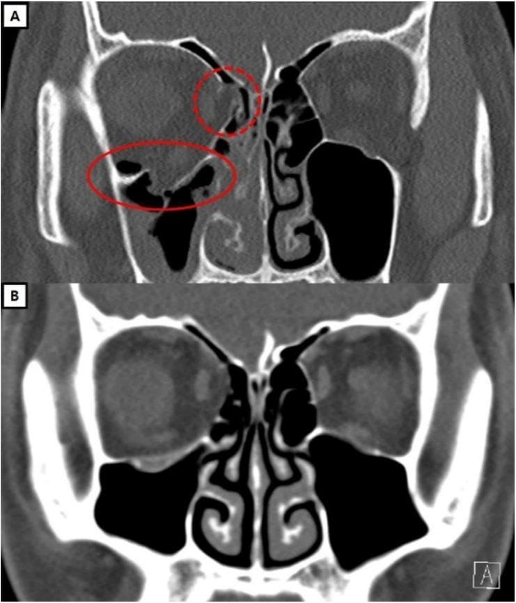 This Comparison Chart consists of two coronal CT scans (A and B) showing a human skull at the level of the orbits, illustrating the surgical management of facial trauma. Scan A (Preoperative) demonstrates a significant blowout fracture of the right orbit. Red annotations highlight two primary defects: a dashed circle indicates a fracture of the medial orbital wall (lamina papyracea) with soft tissue herniation into the ethmoid sinus, and a solid oval indicates a large fracture of the orbital floor with prolapse of orbital fat and inferior rectus muscle into the maxillary sinus. Scan B (Postoperative, one-year follow-up) shows the same anatomical section after reconstructive surgery. The orbital floor and medial wall are restored to their anatomical positions, displaying a continuous bony or implant-supported barrier. The soft tissue contents are fully repositioned within the orbital cavity, and symmetry is restored relative to the contralateral left orbit. This visual aids in teaching clinical radiology and maxillofacial surgery, specifically the identification of blowout fractures and the evaluation of post-surgical reduction and orbital volume restoration.