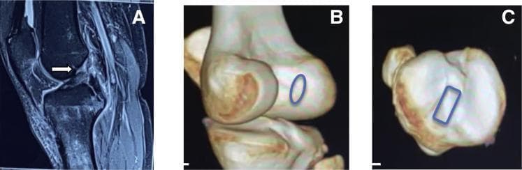 This composite figure provides a diagnostic and anatomical assessment of an anterior cruciate ligament (ACL) injury in a right knee. Panel A is a sagittal proton density fat-suppressed (PDFS) MRI demonstrating a full-thickness ACL tear; a white arrow points to the area of ligamentous discontinuity and high signal intensity at the femoral attachment site. Panels B and C present 3D-CT reconstructions highlighting the native footprint anatomy for preoperative planning. Panel B shows the femoral footprint on the lateral femoral condyle, delineated by a blue oval indicating its natural morphology. Panel C provides a superior view of the proximal tibia, where a blue rectangle marks the rectangular shape and orientation of the tibial footprint. These images illustrate the correlation between diagnostic MRI findings and the 3D anatomical landmarks necessary for anatomic ACL reconstruction.