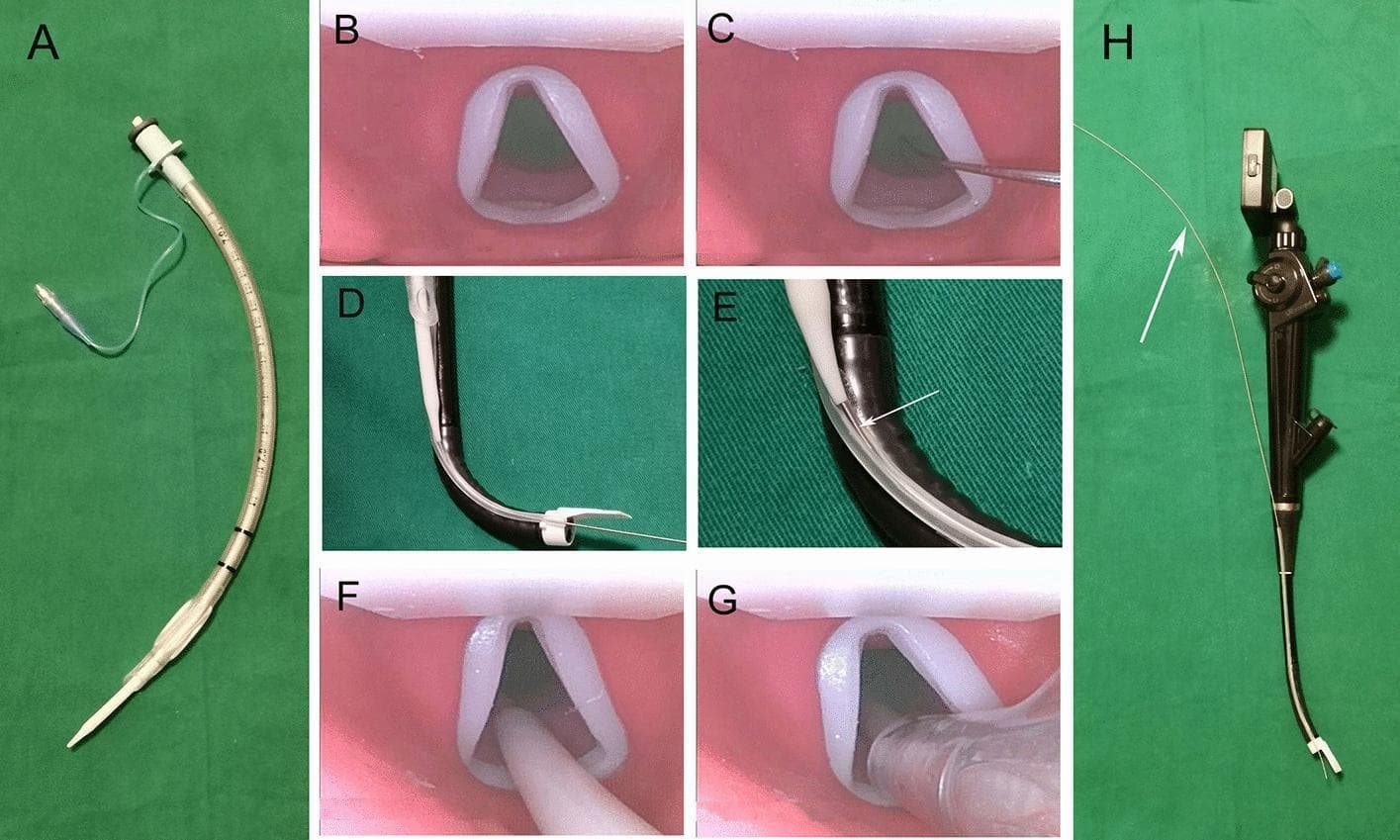 A multi-panel figure illustrating the components and clinical application of a Flexible Video Laryngoscope (FVL) for endotracheal intubation. Image A shows a 7.0 mm endotracheal tube (ETT) mounted over a white guiding tube. Image H displays the fully assembled FVL system, featuring a proximal digital display, a control handle with a thumb lever, and a flexible insertion tube with a side-mounted guiding channel and a pre-installed metal stylet (white arrow). Panels B, C, F, and G provide a first-person endoscopic view of a simulated glottis. Sequential steps are demonstrated: visualization of the glottis (B); insertion of the thin stylet through the glottic opening (C); advancement of the white guiding tube along the stylet (F); and final passage of the ETT into the trachea (G). Panels D and E show the mechanical relationship between the black flexible insertion tube and the guiding components, illustrating how the stylet and ETT slide along the external guiding channel. This clinical series demonstrates difficult airway management techniques using a specialized FVL system.