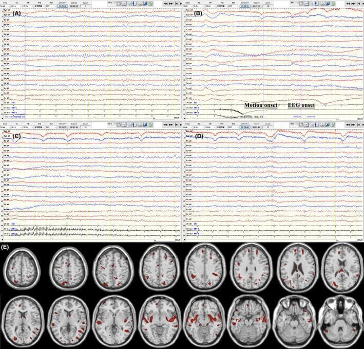 Educational composite image illustrating electroencephalogram (EEG) findings and brain PET imaging in a patient with anti-LGI1 autoimmune encephalitis. Panels A–D present longitudinal EEG traces: (A) shows the interictal phase with stable baseline activity; (B) marks the ictal transition with annotations for 'Motion onset' and 'EEG onset,' characterized by low-amplitude fast rhythms in the right central leads; (C) and (D) demonstrate the evolution of the seizure, showing progressive increases in signal amplitude and rhythmic discharges. Panel E displays axial 18F-FDG-PET scan slices with z-score metabolic mapping overlaid on a structural MRI template. The PET images reveal multifocal, scattered areas of hypermetabolism (indicated by red clusters) involving the bilateral frontal, parietal, temporal, and occipital cortices, as well as the basal ganglia, cingulate gyrus, and cerebellum. This visual synthesis demonstrates the correlation between focal electrical seizure activity and widespread cortical/subcortical metabolic dysfunction characteristic of autoimmune-mediated epilepsy.